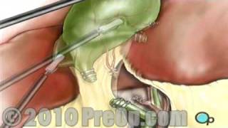 Gallbladder Removal Laparoscopic PreOp® Patient Education [upl. by Burwell184]