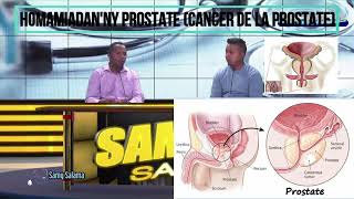 HOMAMIADANNY PROSTATE CANCER DE LA PROSTATE MG [upl. by Megdal]