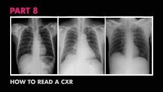 Diaphragms and Pleural Effusion  How to Read a Chest XRay Part 8  MEDZCOOL [upl. by Shellans530]