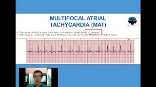 9 Taquicardia Multifocal Atrial [upl. by Demodena]