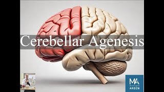 Cerebellar Agenesis [upl. by Grimona46]