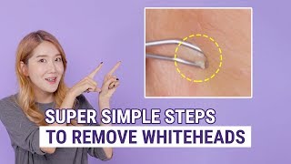 How To Remove Whiteheads  The Best Whitehead Removal amp Prevention Box [upl. by Imre234]