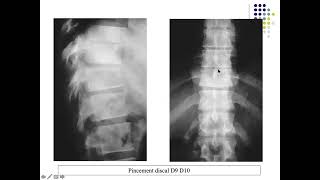 LA SPONDYLODISCITE TUBERCULEUSE ET NON TUBERCULEUSE [upl. by Ellekim830]