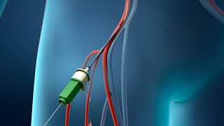 Coronary Angioplasty Femoral Access [upl. by Ettelra585]