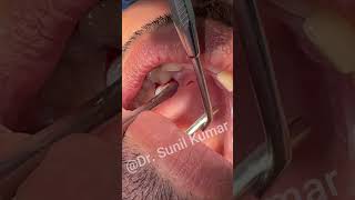 extraction of supernumerary teeth dentalextraction [upl. by Aronael]