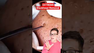 ⚠️ BIGGEST BLACKHEAD REMOVAL  Reaction shorts [upl. by Singh]