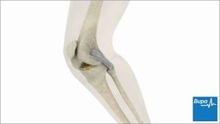 How knee arthroscopy is carried out  Bupa Health [upl. by Marucci374]