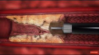 TurboElite laser atherectomy animation [upl. by Murrah]