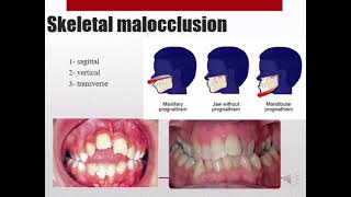 Classification of malocclusion Ortho 411 [upl. by Hylton]