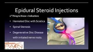 5 Things to Know About Epidural Steroid Injections 602 5076550 [upl. by Ytirahs]