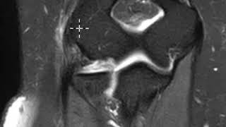 Common extensor tendon tear or elbow [upl. by Ahsinal]