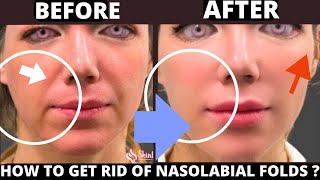 HOW TO GET RID OF NASAL FOLDS  SAGGY SKIN JOWLS CHEEKS FOREHEAD LINES FROWN LINES LAUGH LINES [upl. by Beryl310]