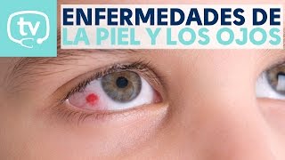 ¿Cómo afectan las enfermedades de la piel a los ojos [upl. by Dnomar]