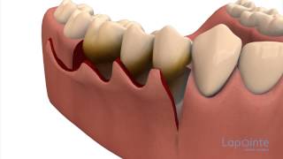 Periodontal flap approach surgery  Lapointe dental centres [upl. by Fraya]