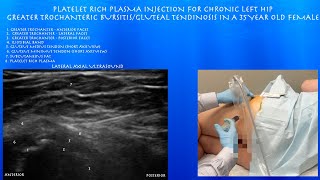 Ultrasound of Greater Trochanteric Bursitis Platelet Rich Plasma Injection in a 35 Year Old Female [upl. by Nyberg]