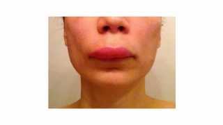 Angioedema and Hives Treatment using natural home remedies and healthy diet [upl. by Harbed]