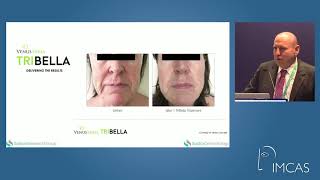 IMCAS Presentation with Dr Neil Sadick on TriBella™ [upl. by Goldfinch]