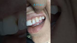 Light Cure Composite Filling By Haider dentalartbyhaider filling [upl. by Aillicsirp]