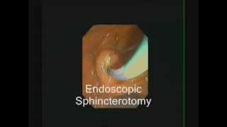 ERCP  Large Sphincterotomy for Large Stones  STEFANOS DOKAS  The ERCP Channel [upl. by Hassi]