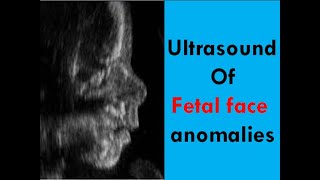 Ultrasound of fetal face anomalies [upl. by Clevie]