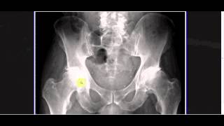 Interpreting XRays of the Pelvis Hip Joint and Femur [upl. by Aroc]