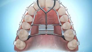 Hyrax Rapid Palatal Expansion Braces During [upl. by Eramal637]