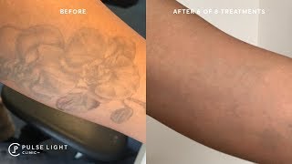 GETTING RID OF MY TATTOOS FOREVER  Tattoo Removal on Dark Skin [upl. by Nodrog]