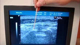 Ultrasound Guided Caudal Epidural Injection [upl. by Sanger602]