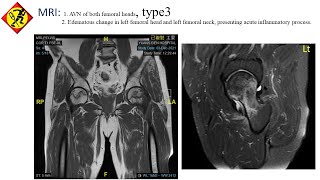 髖關節股骨頭壞死，PRP骨髓內注射 [upl. by Kwapong]