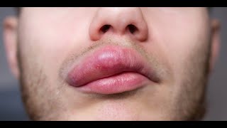 Angioedema  Symptoms and Causes [upl. by Rome940]