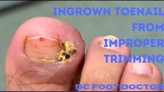 Ingrown Toenail Removal After Improper Trimming [upl. by Australia154]