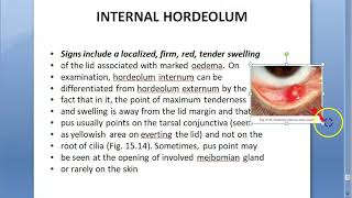 Ophthalmology 378 Internal Hordeolum Meibomian gland infection [upl. by Sathrum869]