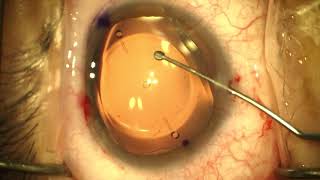 Toric implantable collamer lens ICL rotation [upl. by Early]