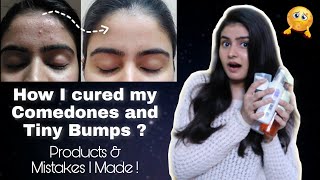 How to treat Tiny Bumps Comedones amp Skin Texture  Kashika Chauhan [upl. by Elinet]