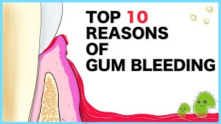 Gum Bleeding Top 10 causes [upl. by Rothschild]