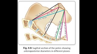 Obstetrics 121 Pelvis Pelvic Inlet Conjugate Diameter Anatomical True Obstetric Diagonal [upl. by Beesley799]