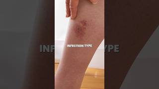 Basic Treatment for Cellulitis leghealth shortsfeed vascularaccess vascularhealth [upl. by Mika]