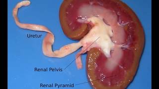 coagulative necrosis kidney gross and microscopic features for medical students [upl. by Marv]