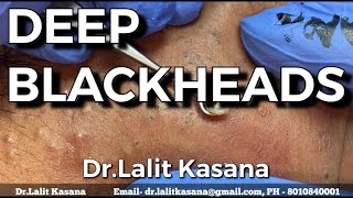 DEEP OLD BLACKHEADS REMOVAL BY DrLalit Kasana 24 Jan 2020 [upl. by Campball]