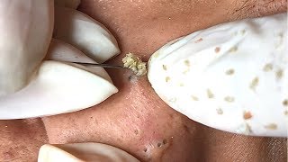 ACNE BLACKHEADS WHITEHEADS REMOVAL on face 38  How to get rid of pimple easy part [upl. by Anoerb]