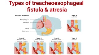 Types of treacheoesophageal fistula amp Atresia ll TEF ll pediatrics ll medical education [upl. by Hootman]