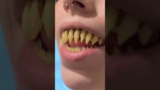 Why Is This FRIGHTENING Tooth Trend Is Taking Over 🧛🦷 [upl. by Adnac]