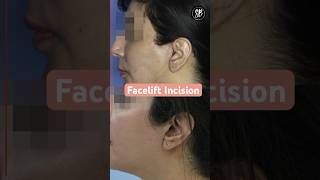 Facelift Incisions  Facelift Surgery Before After  Facelift Surgery in Hindi  SB Aesthetics [upl. by Ardnosal591]