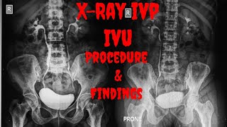 XRAY IVP  XRAY IVU Procedure Indications Findings  Intravenous Urogram  Intravenous Pyelogram [upl. by Acirt43]