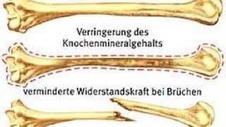 Osteoporose Knochenschwund und die richtige Ernährung [upl. by Alesandrini]