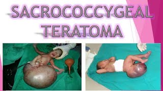 WHAT IS SACROCOCCYGEAL TERATOMA SCT ALL ABOUT ITS CAUSES SYMPTOMS PATHOLOGY DIAGNOSIS TREATMENT [upl. by Toomin]