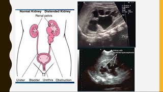 A Class On ULTRASOUND IN ACUTE ABDOMEN By Dr Kiranmaiy Dept Of Radiology [upl. by Kamal]