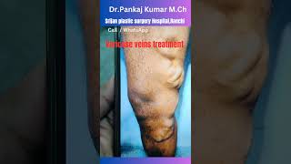 Best varicose veins treatment Laser treatment of varicose veinsvaricose veins treatment in Ranchi [upl. by Dreeda]