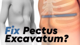 Pectus Excavatum and the Nuss Procedure [upl. by Aneehc]