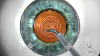 Stephen Slade MD Laser Cataract Surgery Animation [upl. by Reed]